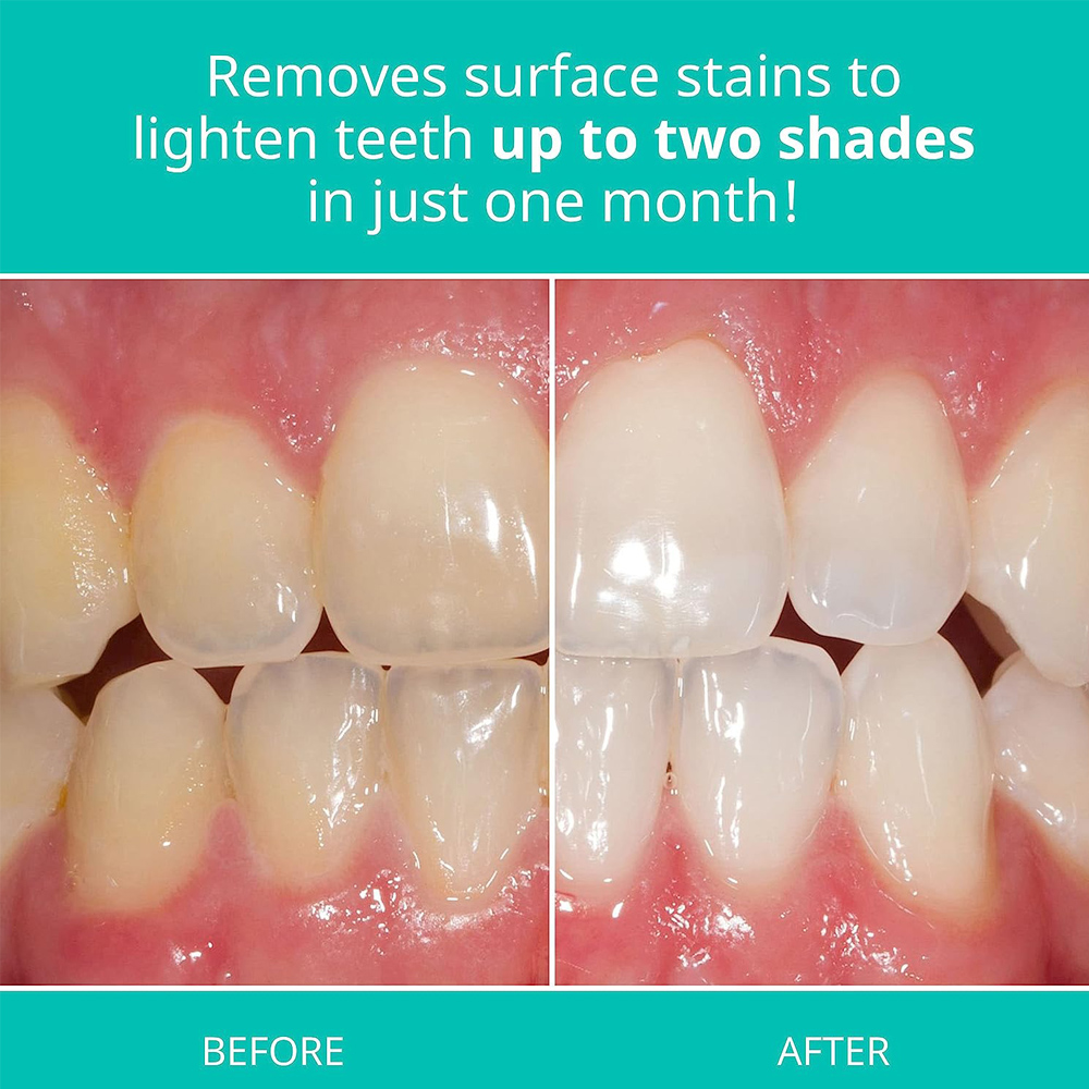 Opalescence beyazlatma diş mac - Teeth Whitening Gel Opalescence incelemesi ve fiyatı
