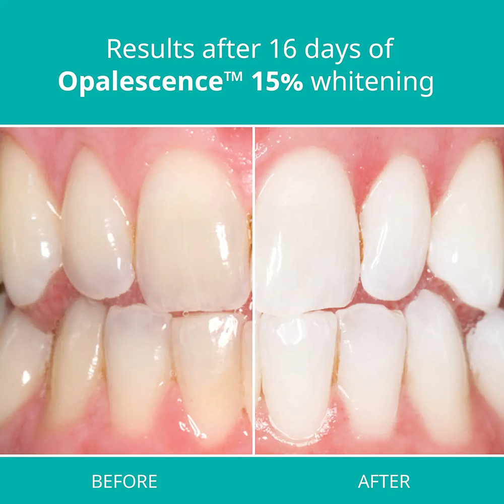 Opalescence Profesyonel Beyazl - Teeth Whitening Gel Opalescence incelemesi ve fiyatı