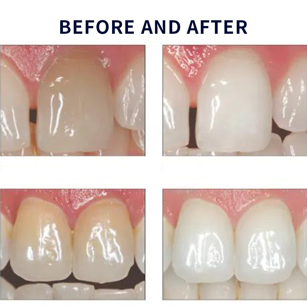 Opalescence beyazlatma 20% PF  - Teeth Whitening Gel Peroxide incelemesi ve fiyatı