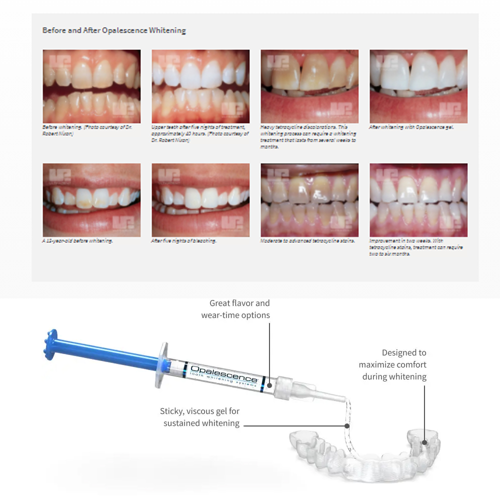 Opalescence beyazlatma 20% PF  - Teeth Whitening Gel Peroxide incelemesi ve fiyatı