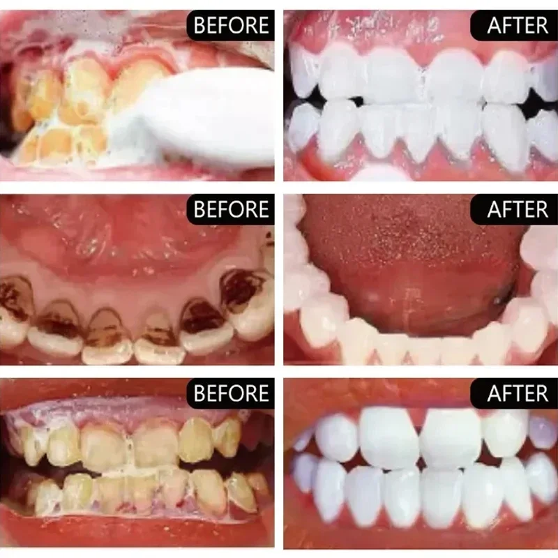 Hızlı Duman Lekelerini Kaldır  - Teeth Whitening Fast incelemesi ve fiyatı