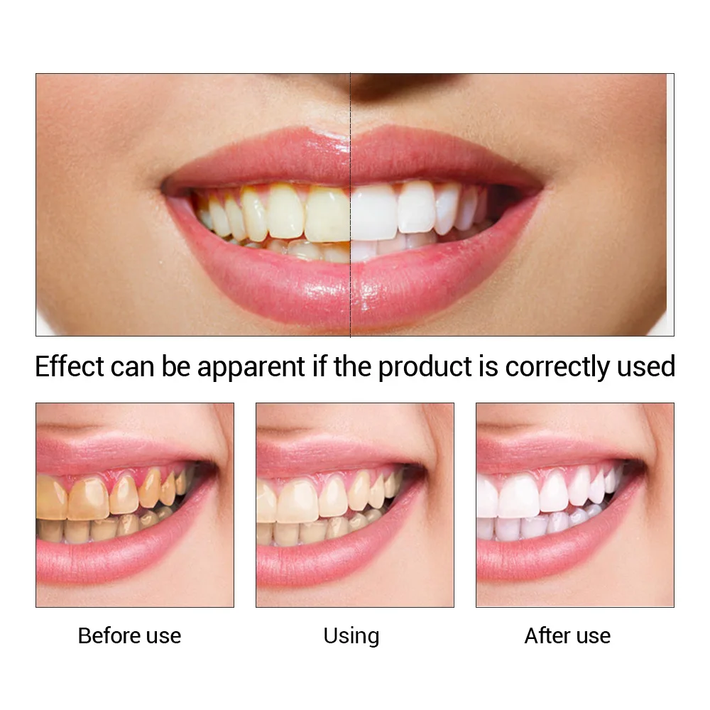 FTEENPLY diş beyazlatma özü to - Teeth Whitening Results incelemesi ve fiyatı