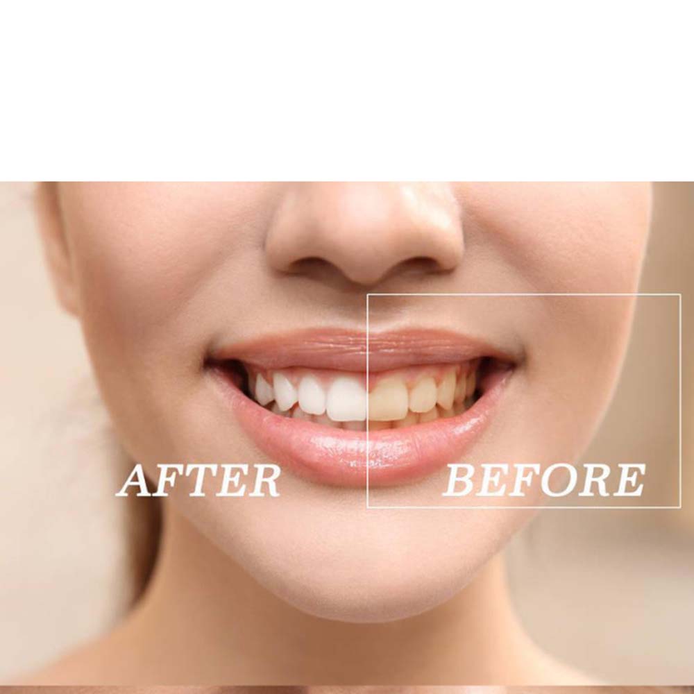 En kaliteli peroksit diş beyaz - Teeth Whitening Gel Peroxide incelemesi ve fiyatı