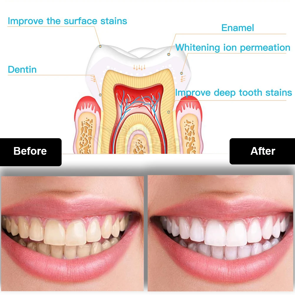 Diş Diş Beyazlatma Kiti Mini 1 - Teeth Whitening Gel Peroxide incelemesi ve fiyatı