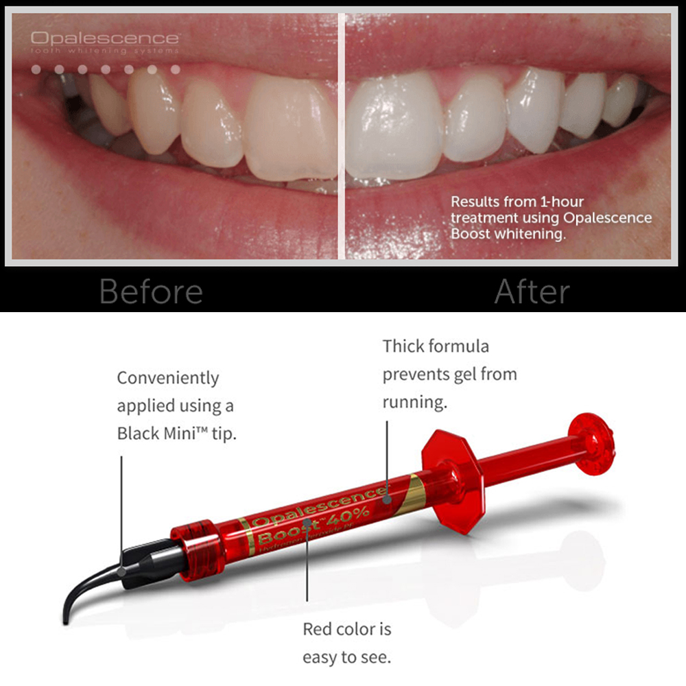 Ultradent Opalescence Boost PF - Teeth Whitening Gel Opalescence incelemesi ve fiyatı