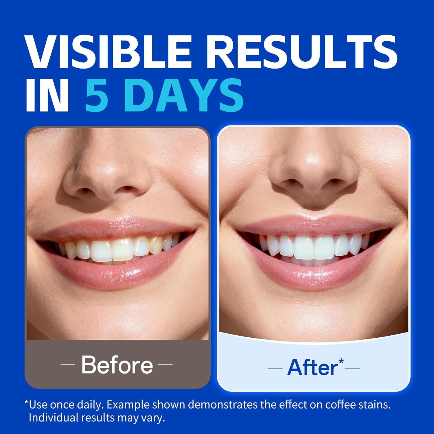 KHAZIX Diş Beyazlatma Bantları - Teeth Whitening Oil Pulling incelemesi ve fiyatı
